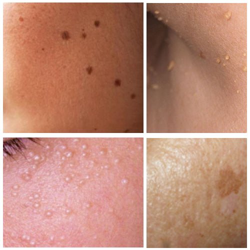 [S190054 - 10] Zap Away Skin BLEMISHES! Say Good bye to Seborrheic keratosis, Solar Lentigo (aka Liver spots/ Age spots), Milia seeds (aka Oil seeds), Skin Tags, and Moles