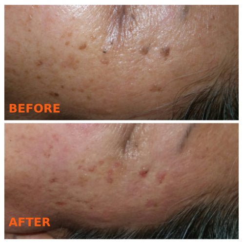 [S190054A][ALA CARTE, Minimum $30] Zap Away Skin BLEMISHES! Say Good bye to Seborrheic keratosis, Solar Lentigo (aka Liver spots/ Age spots), Milia seeds (aka Oil seeds), Skin Tags, and Moles