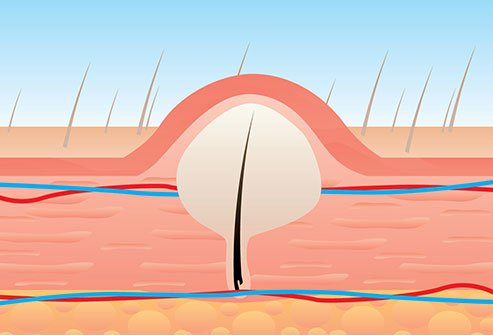 [S190056 - 10] Underarm Ingrown Hair Extraction