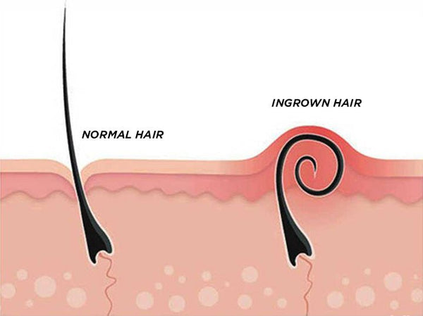 [S190057 - 15] Brazilian Ingrown Hair Extraction